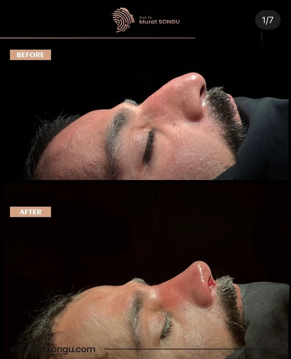 Rinoplastia com Pele Espessa Antes & Depois