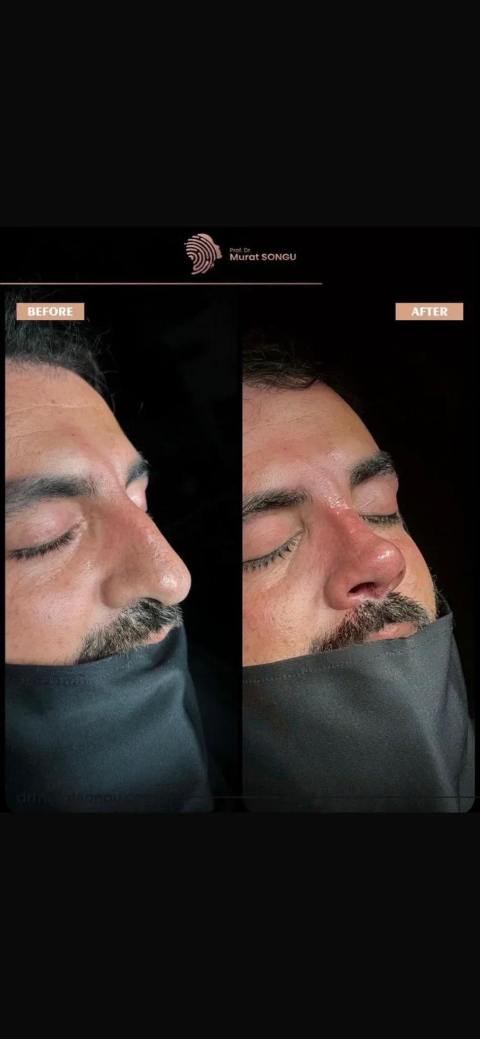 Rinoplastia com Pele Espessa Antes & Depois