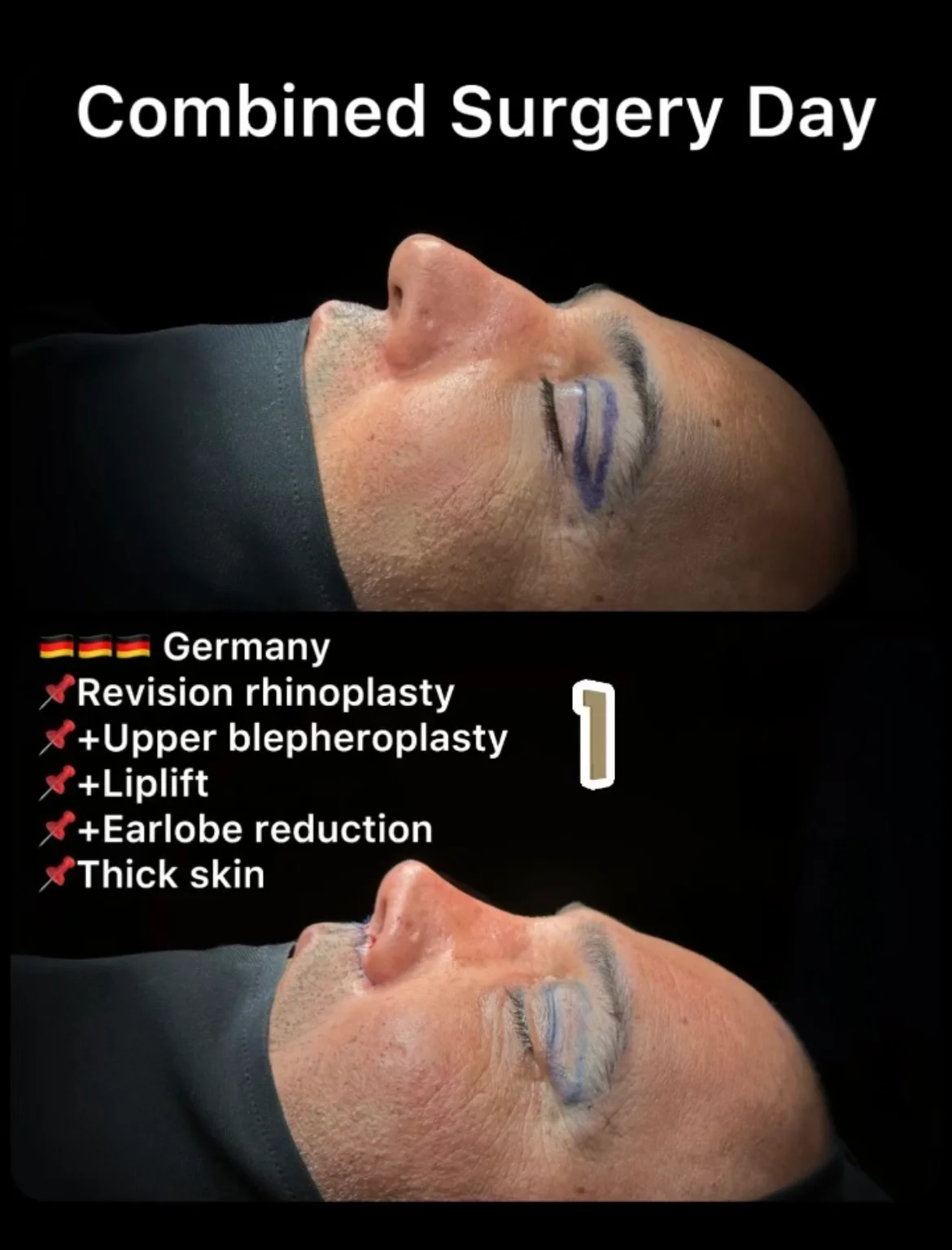 Rinoplastia com Pele Espessa Antes & Depois