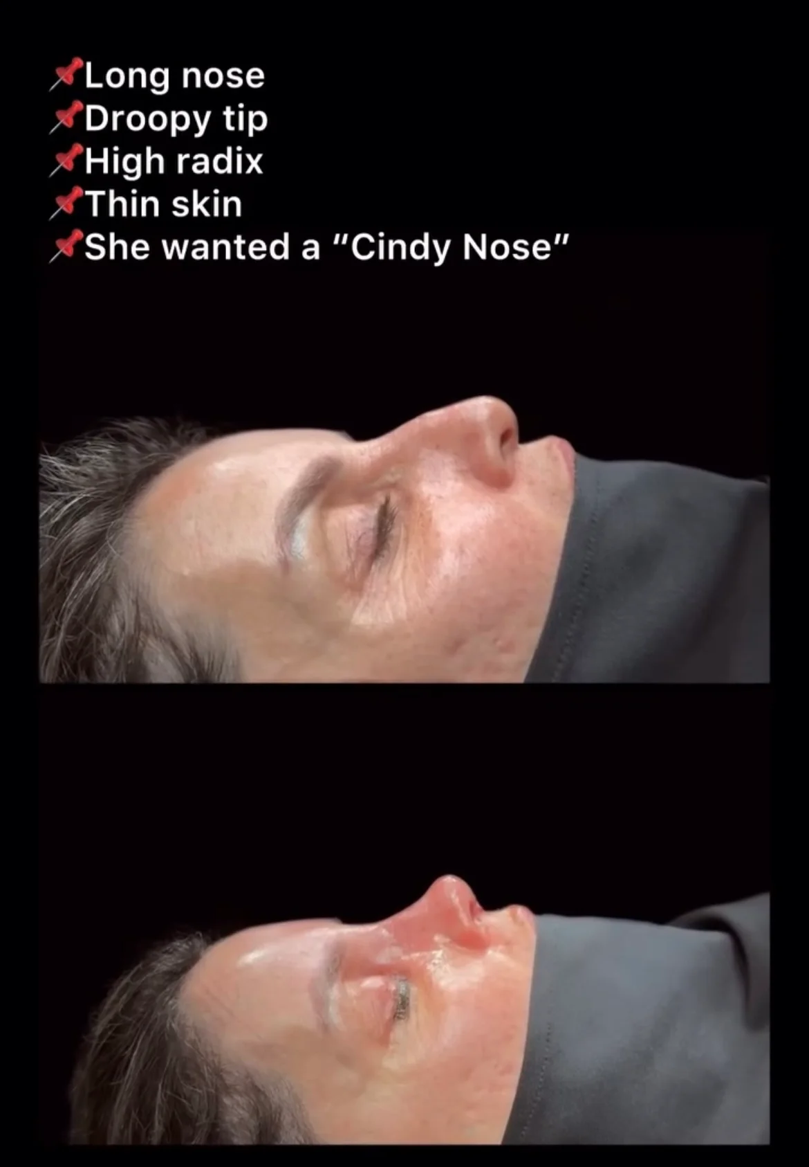 Rinoplastia com Pele Espessa Antes & Depois