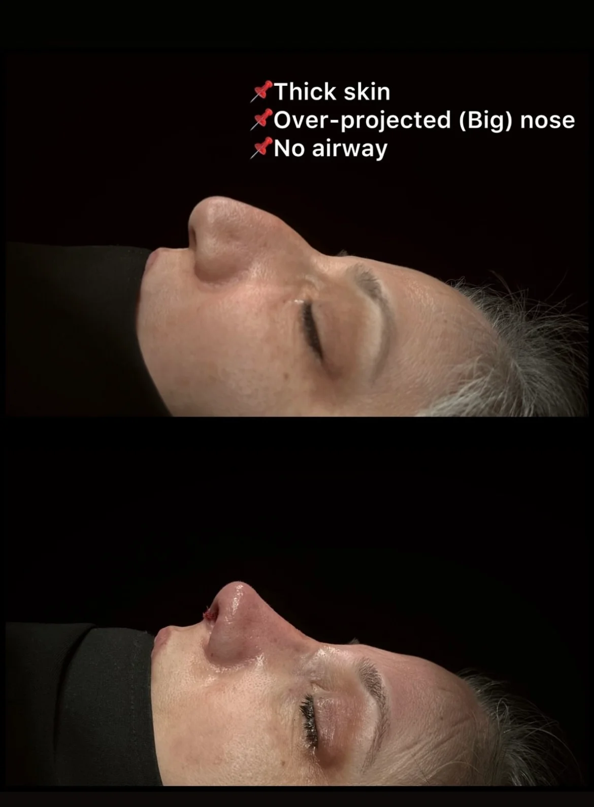 Rinoplastia com Pele Espessa Antes & Depois