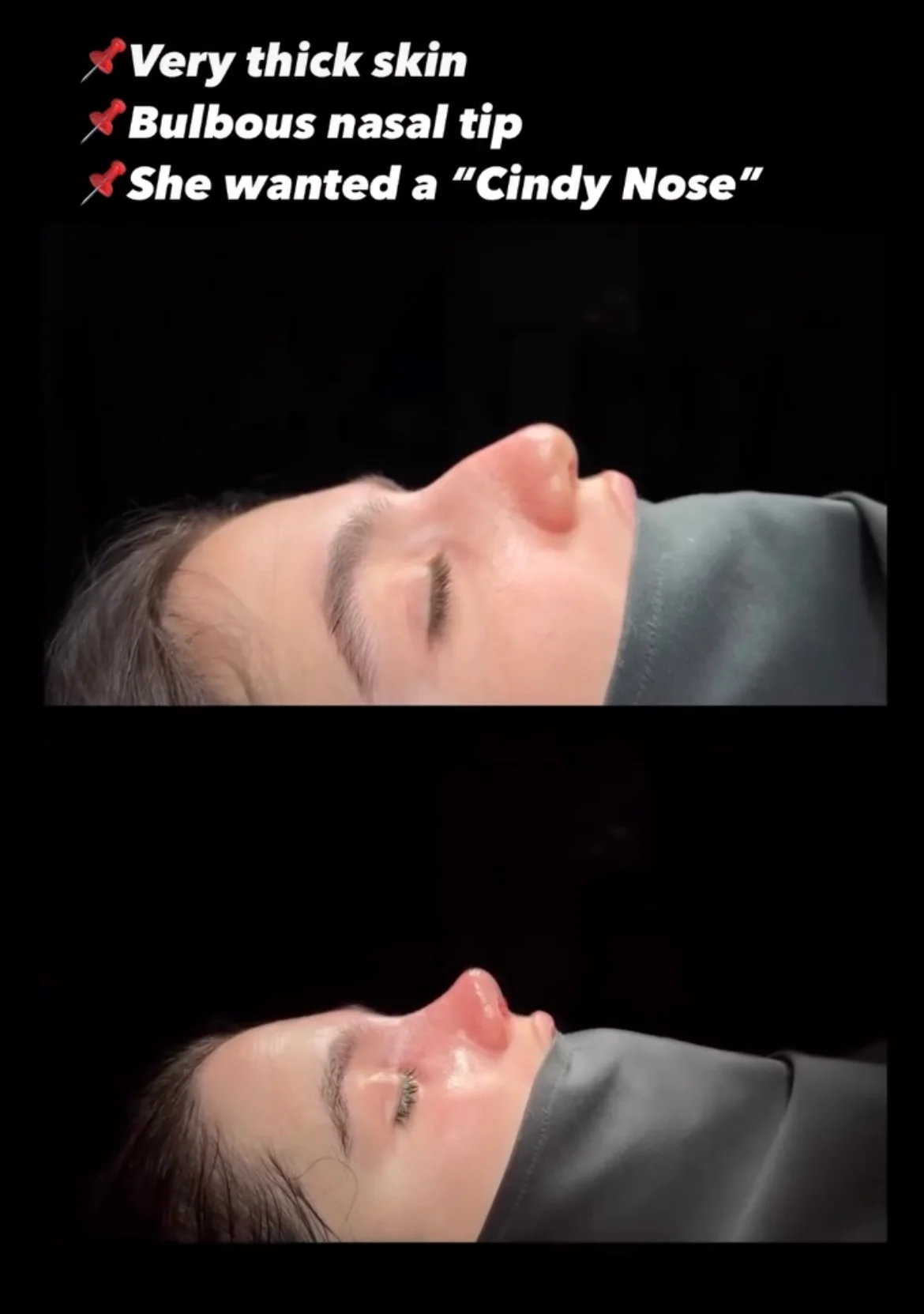 Rinoplastia com Pele Espessa Antes & Depois