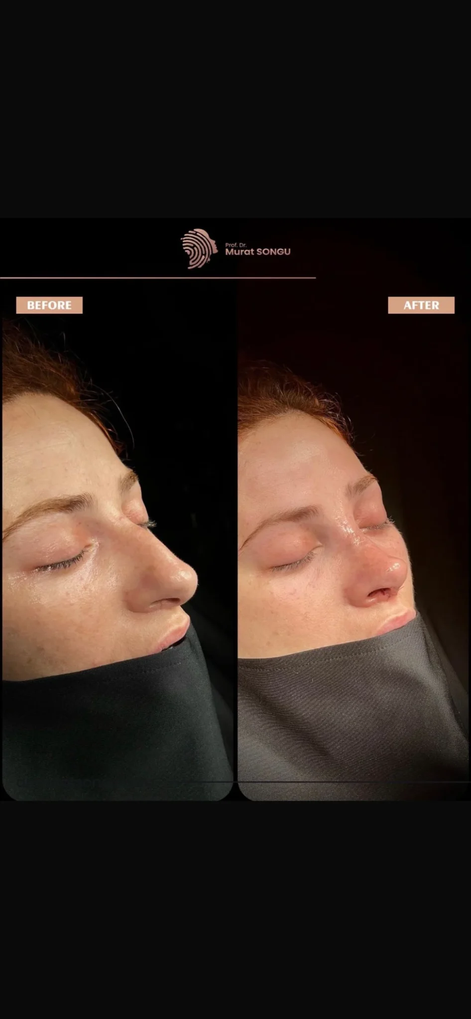 Rinoplastia com Pele Espessa Antes & Depois