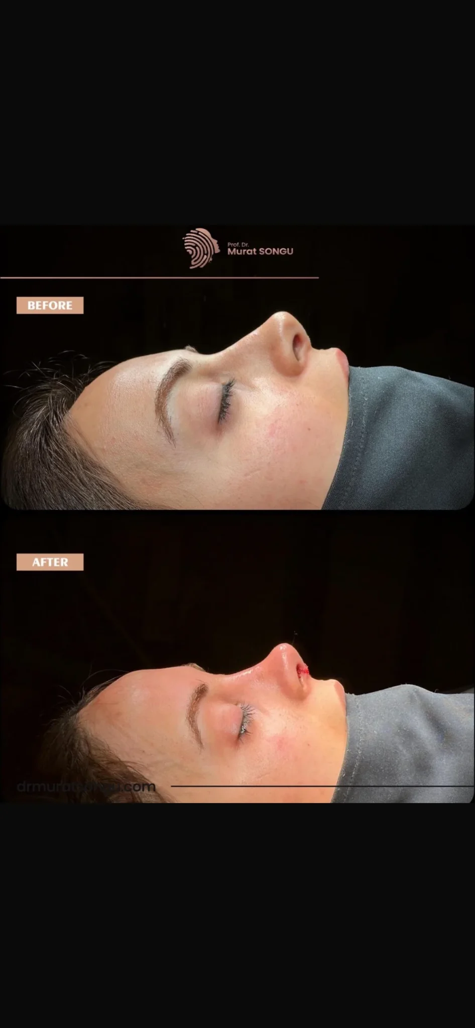 Rinoplastia de Revisão Antes & Depois