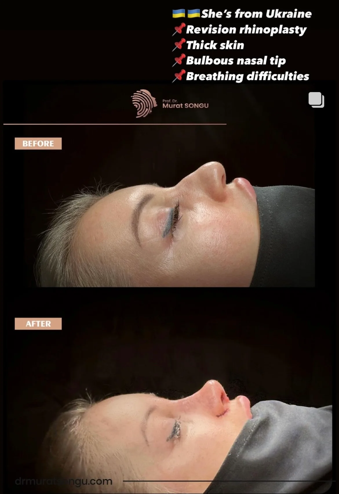 Rinoplastia de Revisão Antes & Depois