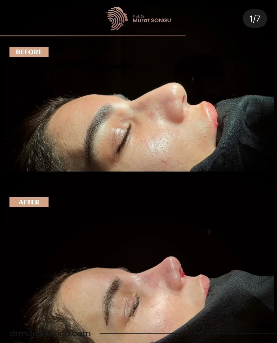 Rinoplastia de Revisión Antes y Después Rinoplastia de Revisión Antes y Después