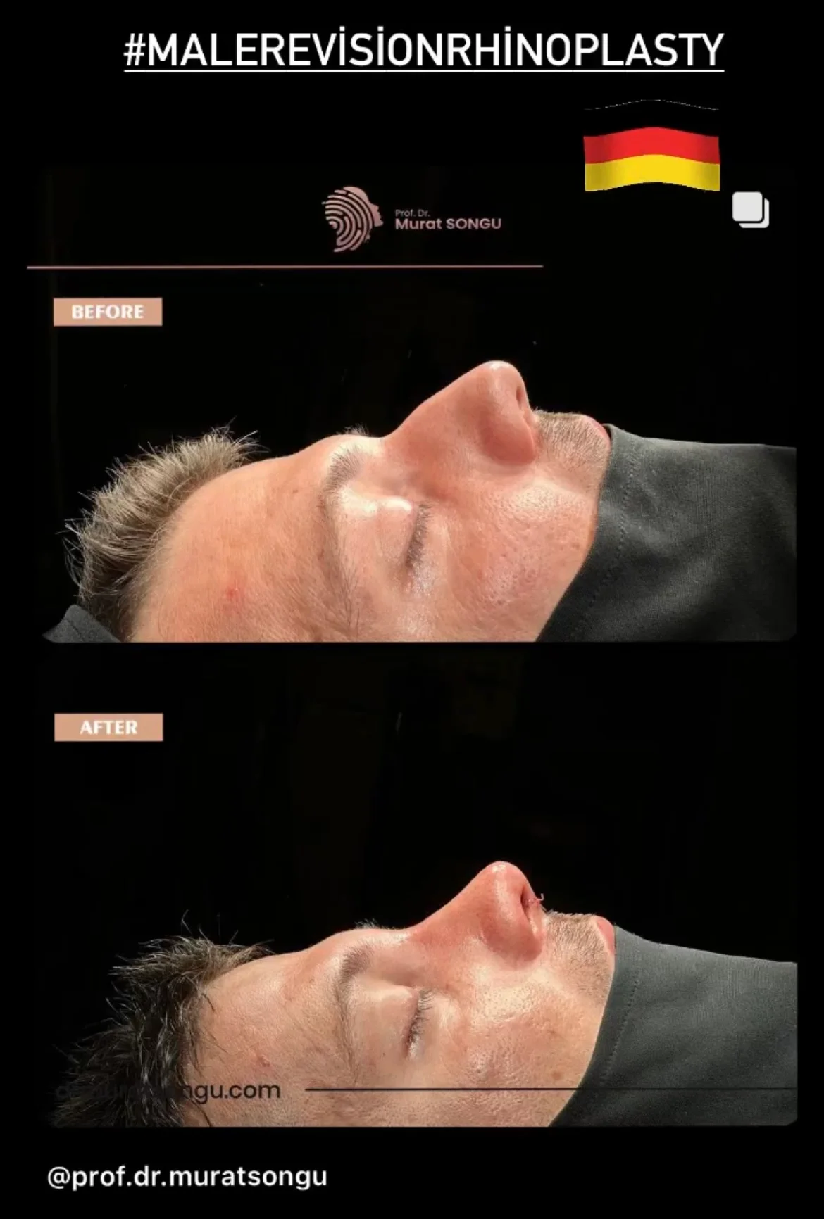 Rinoplastia de Revisión Antes y Después Rinoplastia de Revisión Antes y Después