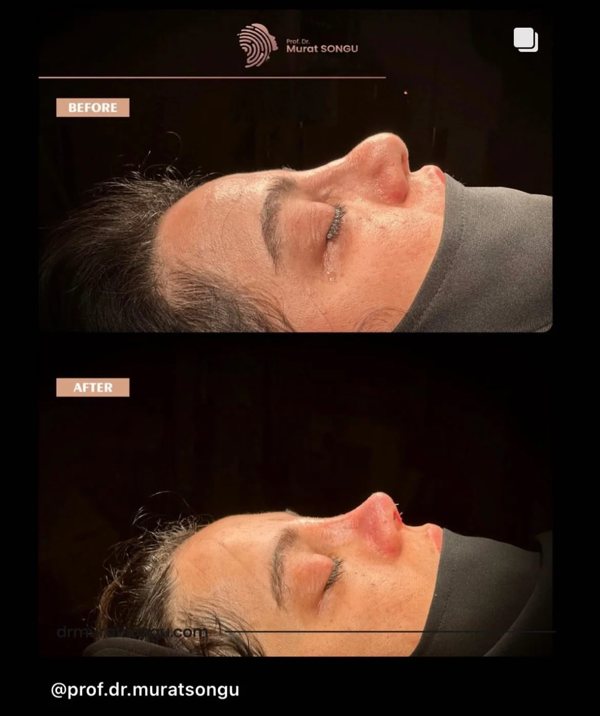 Rinoplastia de Revisión Antes y Después Rinoplastia de Revisión Antes y Después