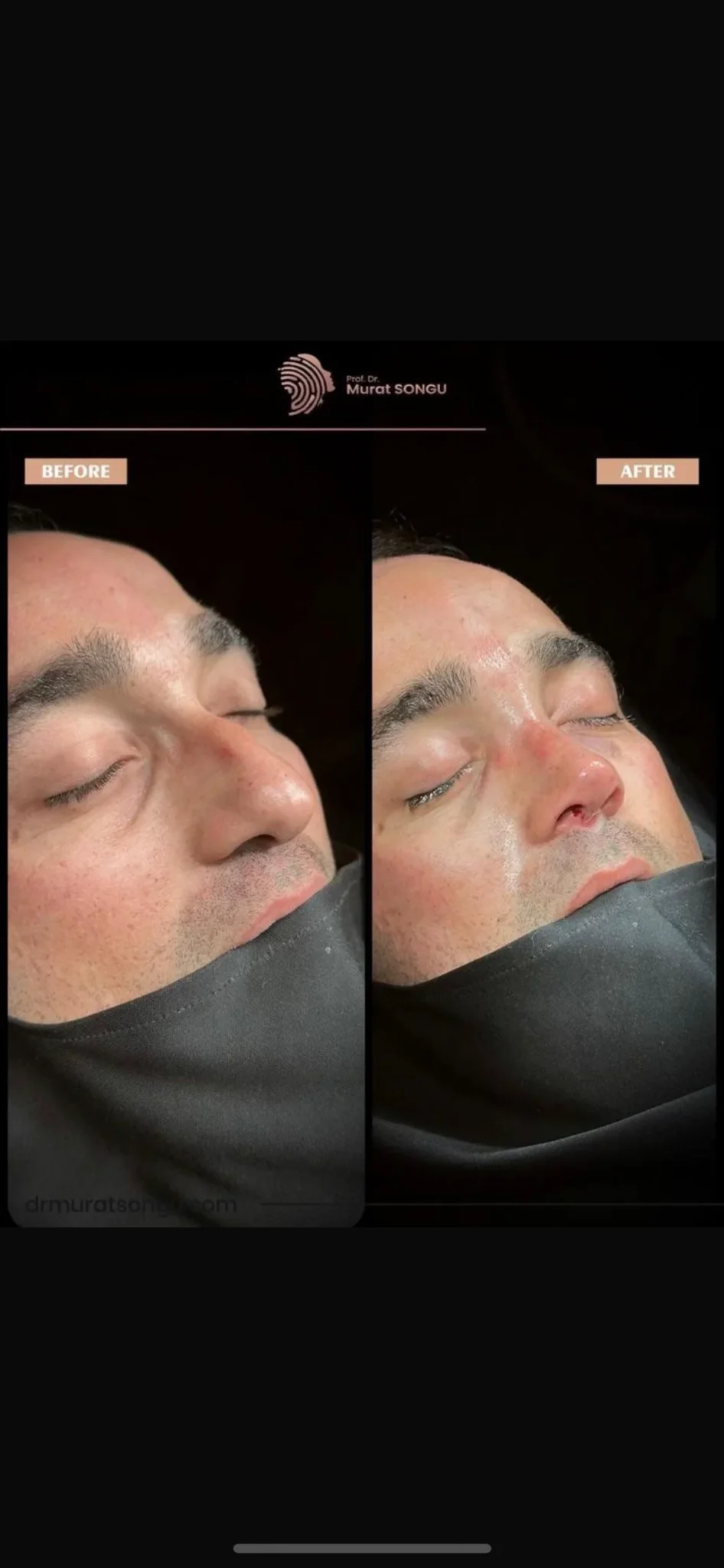 Rinoplastia de Revisión Antes y Después Rinoplastia de Revisión Antes y Después