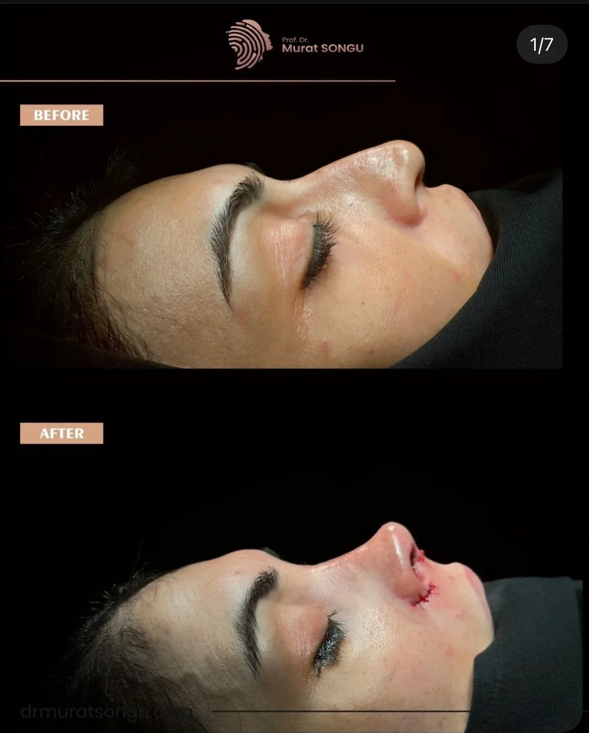 Rinoplastia en Piel Gruesa Antes y Después