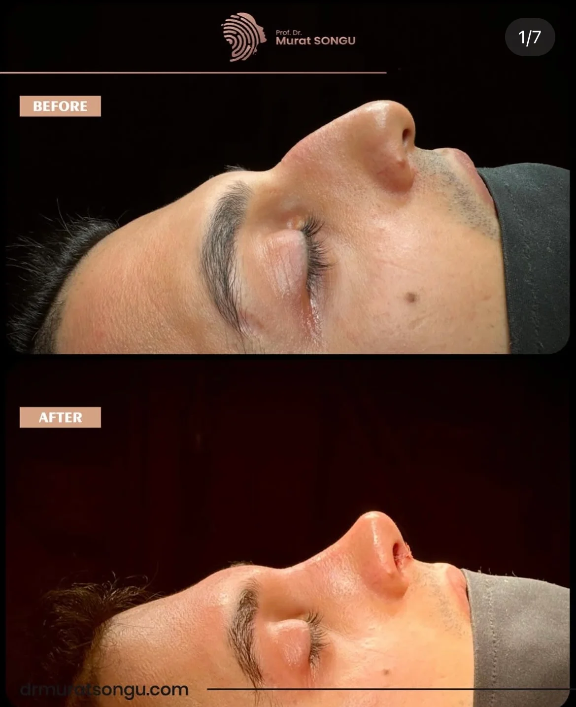 Rinoplastia en Piel Gruesa Antes y Después