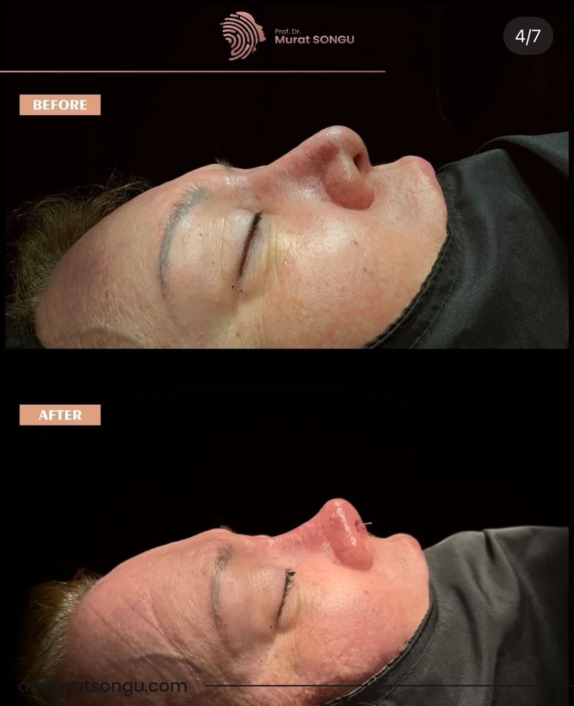 Rinoplastia en Piel Gruesa Antes y Después