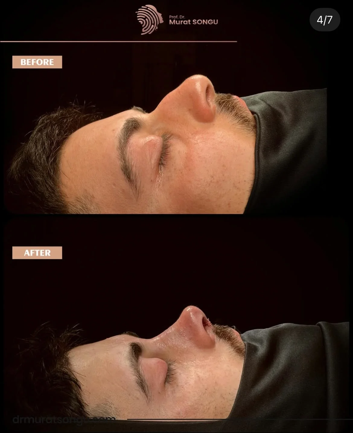 Rinoplastia en Piel Gruesa Antes y Después