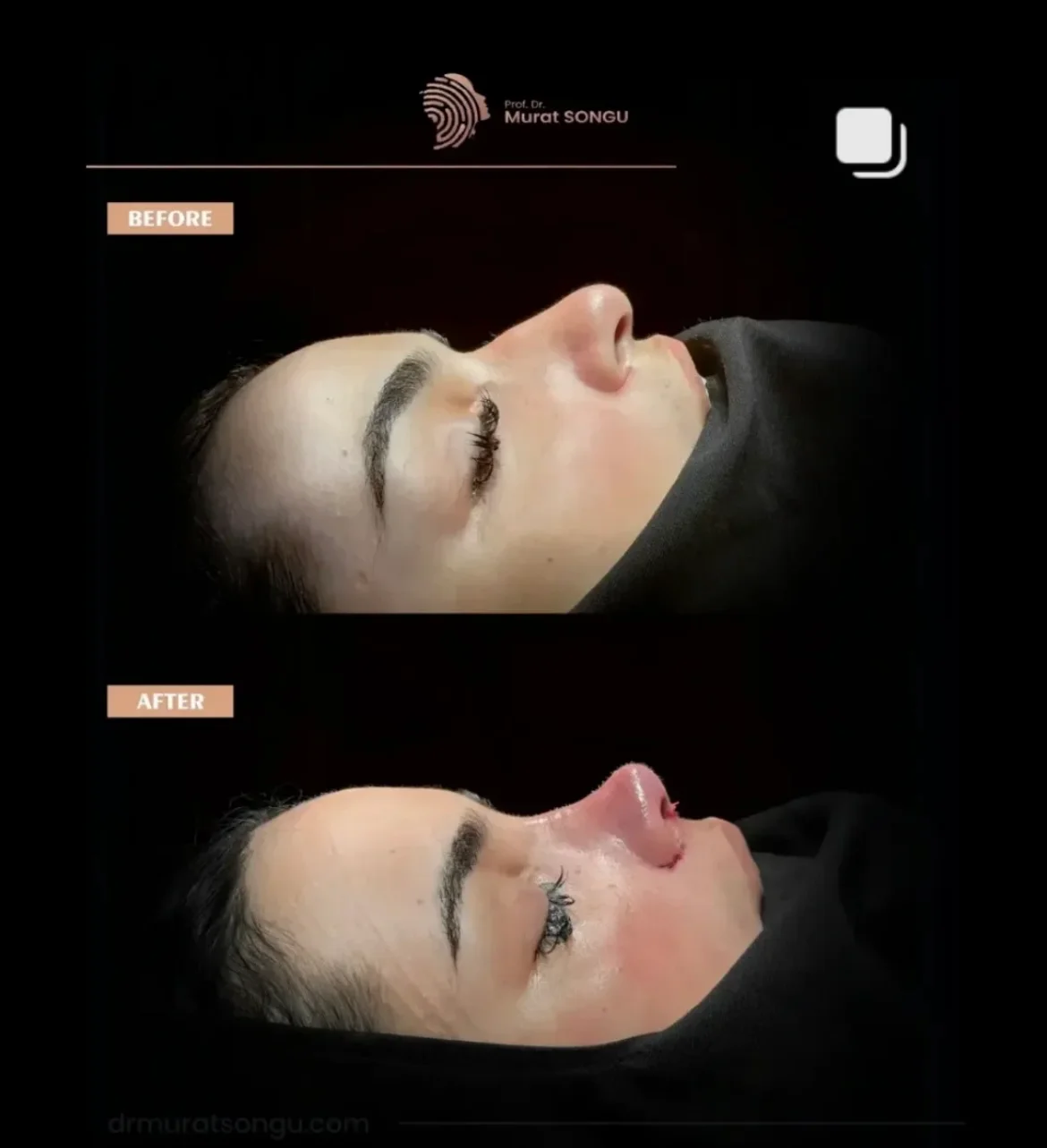 Rinoplastia en Piel Gruesa Antes y Después