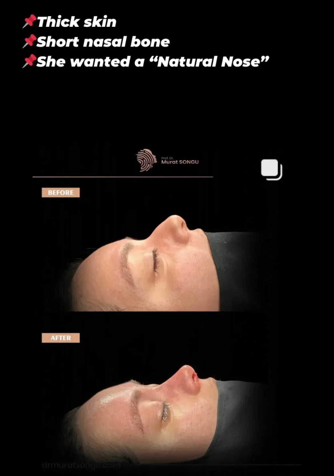 Rinoplastia en Piel Gruesa Antes y Después