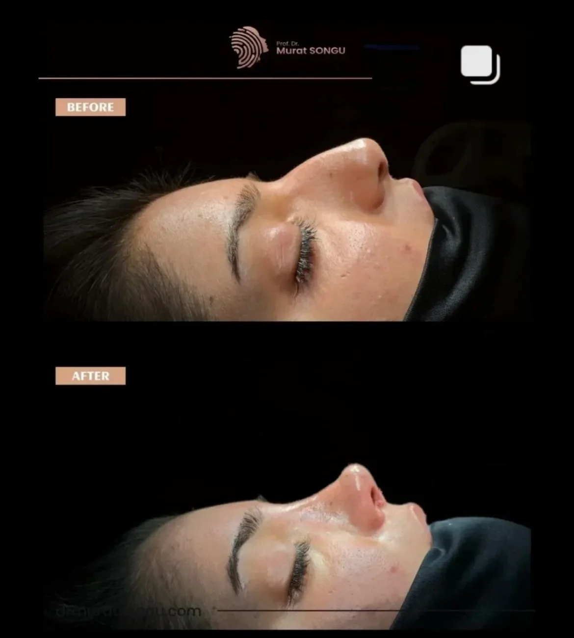 Rinoplastia en Piel Gruesa Antes y Después