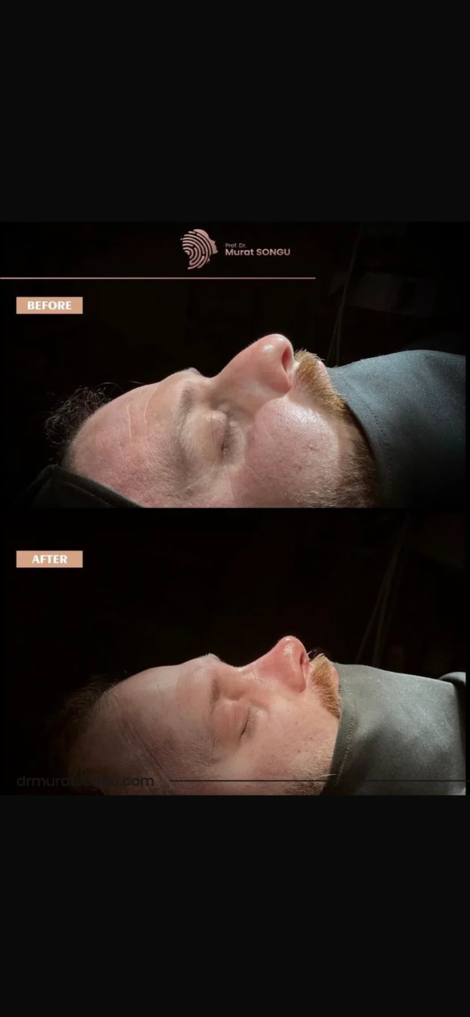 Rinoplastia en Piel Gruesa Antes y Después