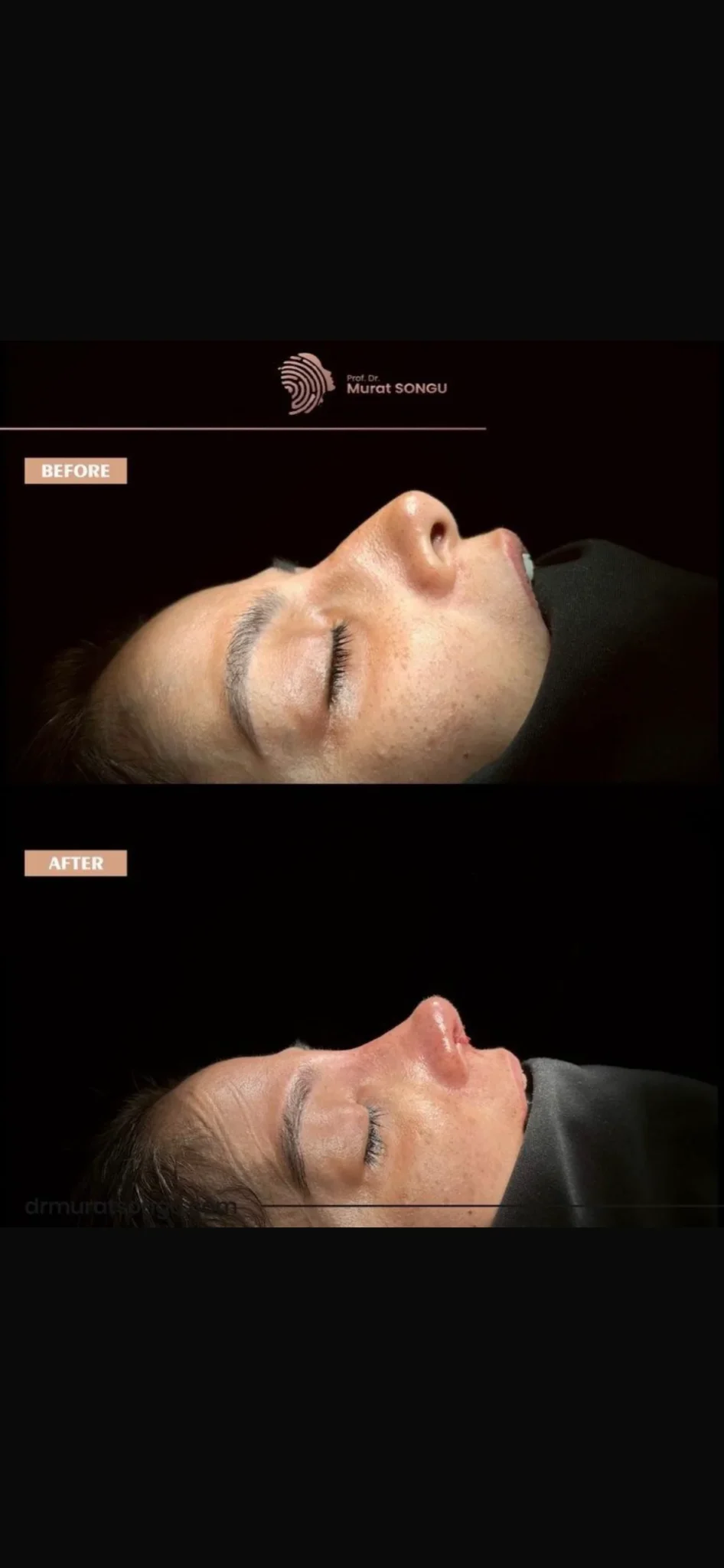 Rinoplastie Piele Groasă Înainte & După