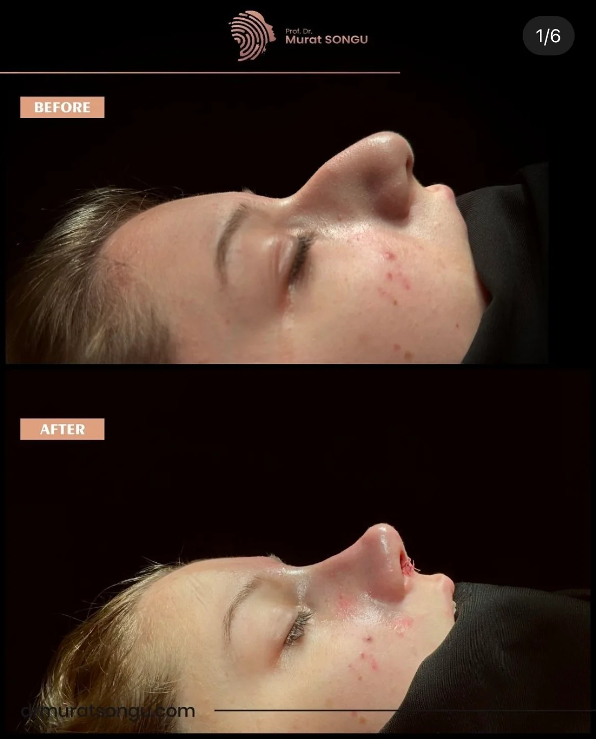 Rinoplastie Piele Groasă Înainte & După