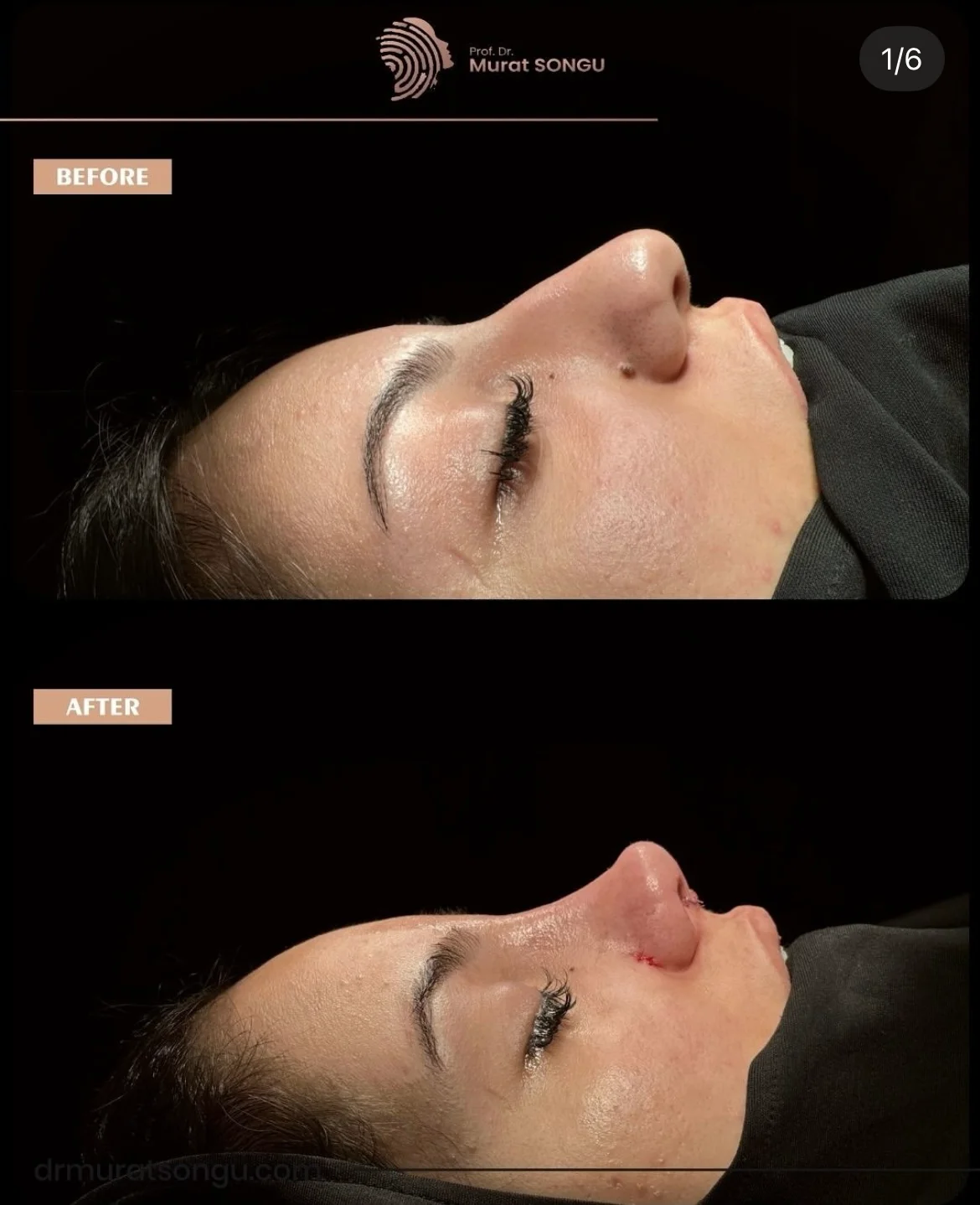 Rinoplastie Piele Groasă Înainte & După