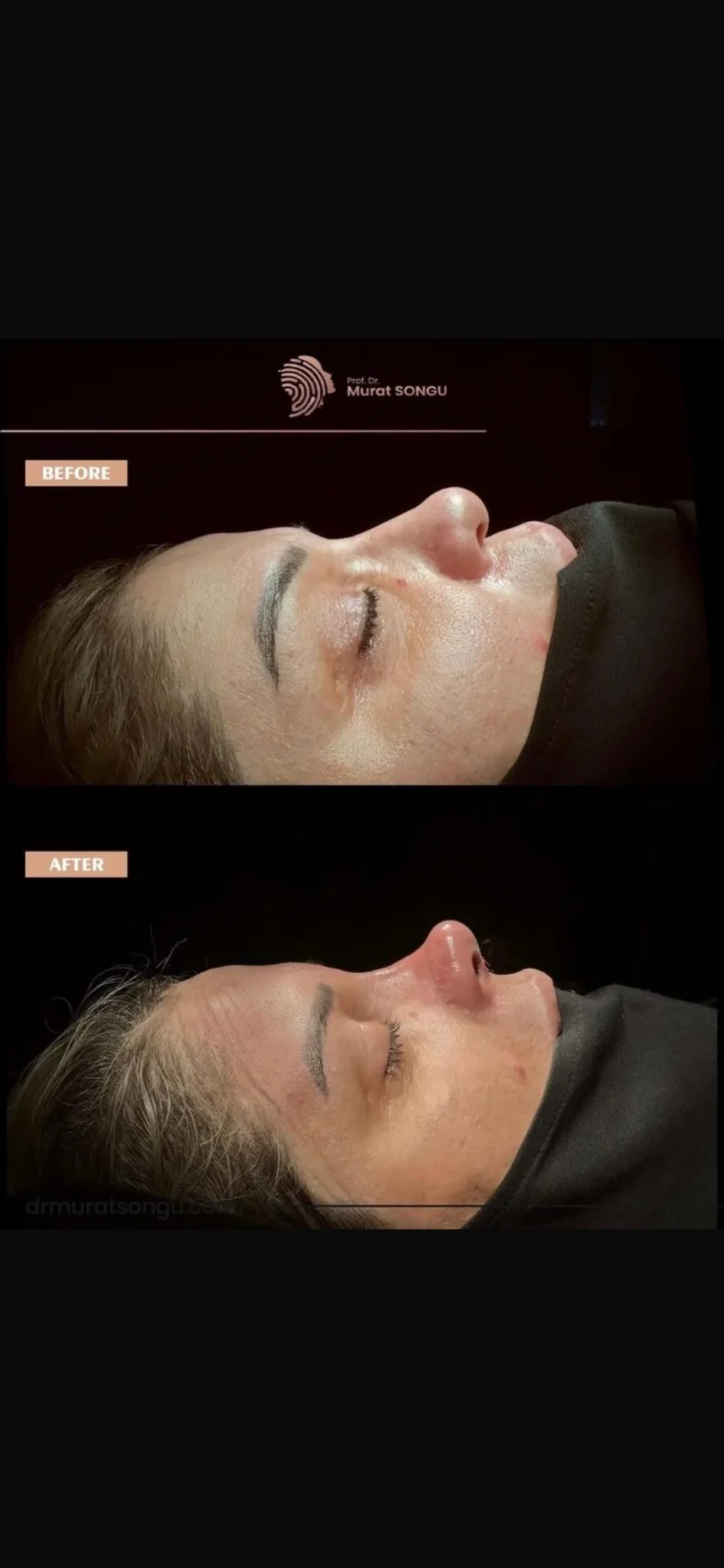 Rinoplastie Piele Groasă Înainte & După