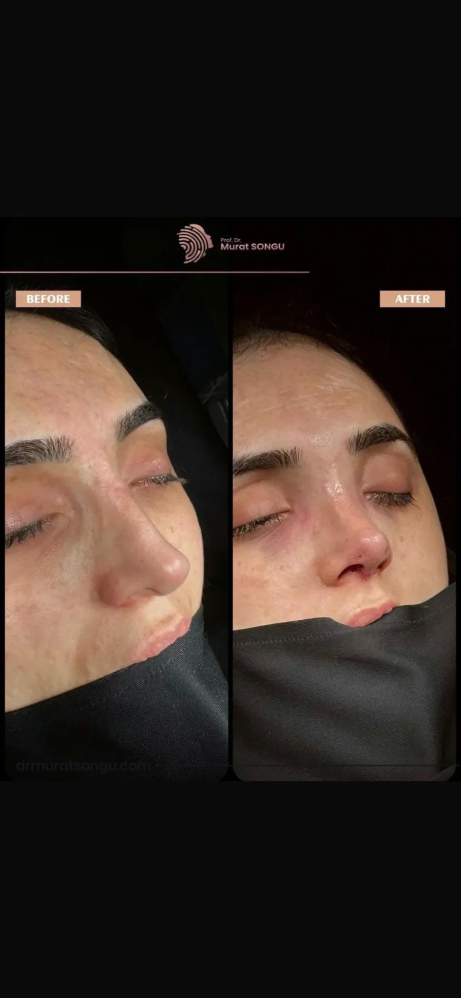 Rinoplastie de Revizie Înainte & După