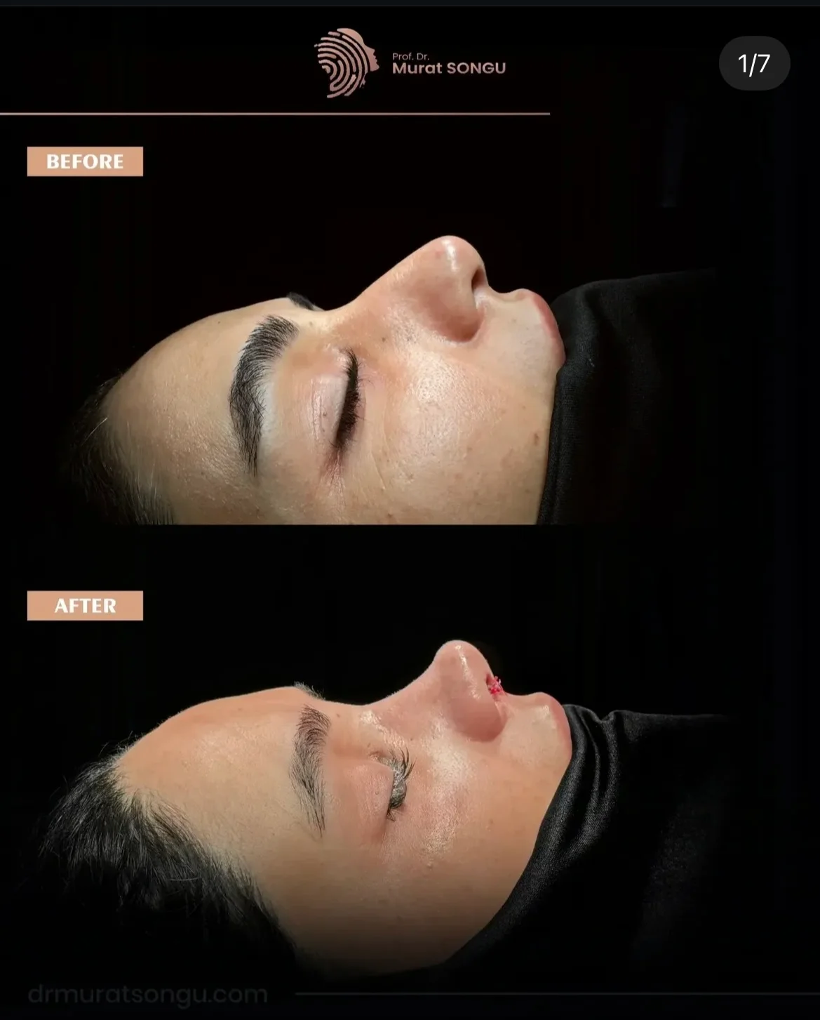 Rinoplastie de Revizie Înainte & După