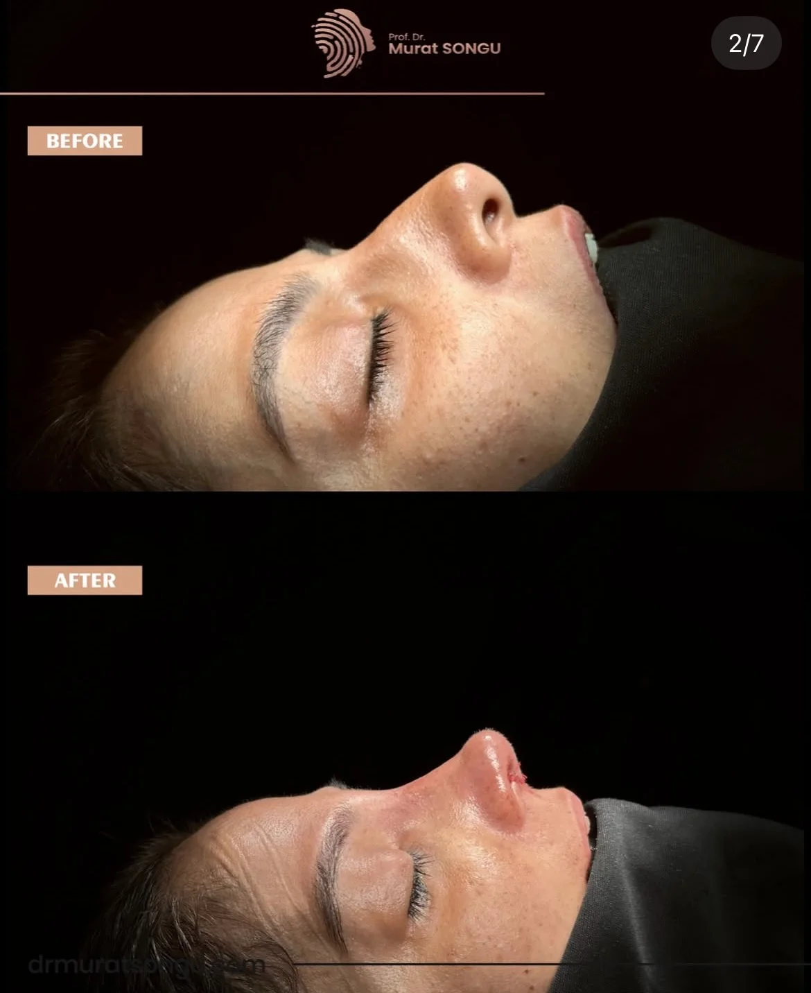 Rinoplastie de Revizie Înainte & După