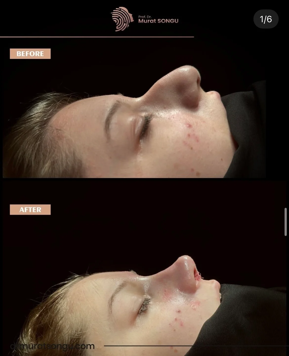 Rinoplastie de Revizie Înainte & După