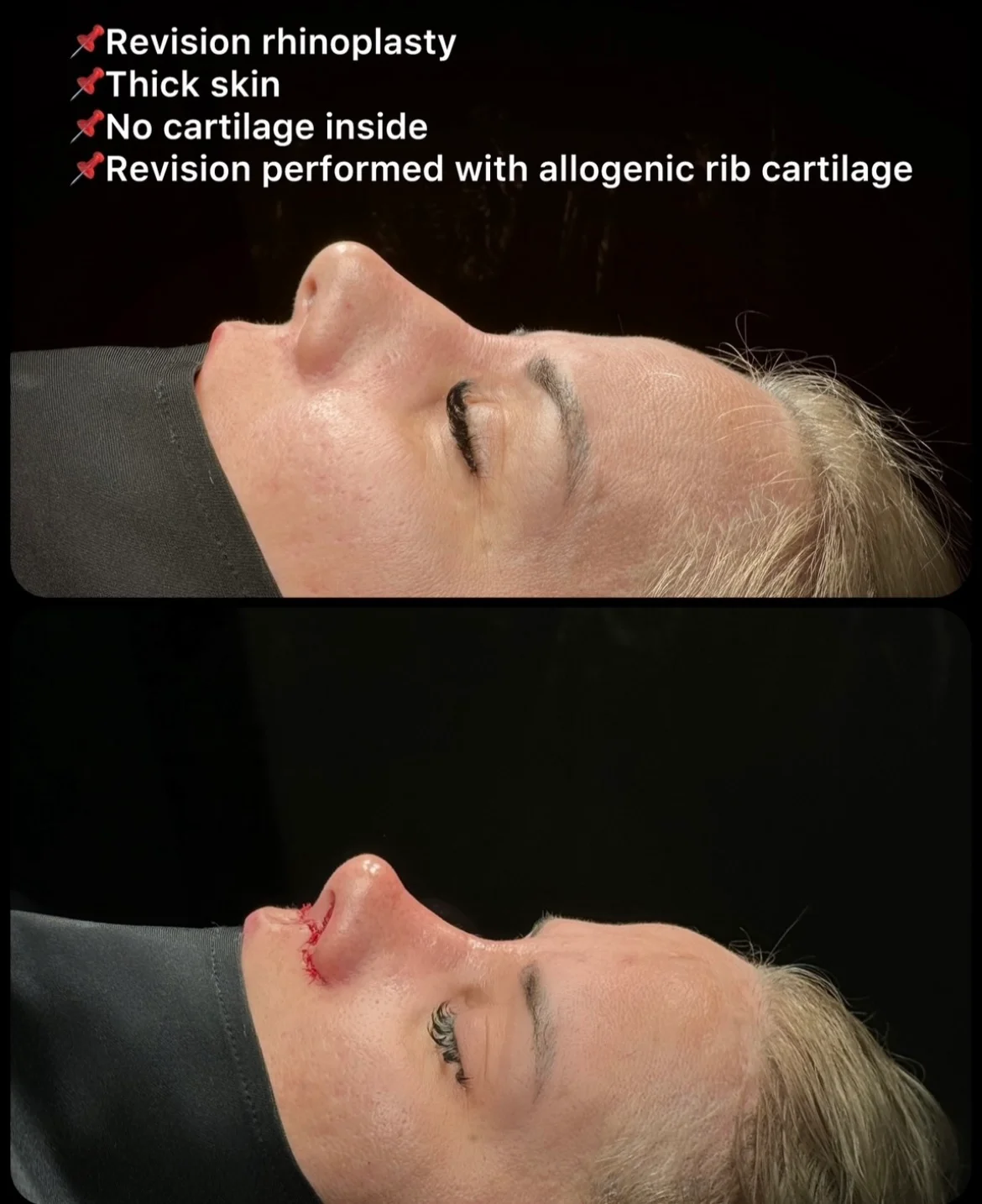 Rinoplastie de Revizie Înainte & După