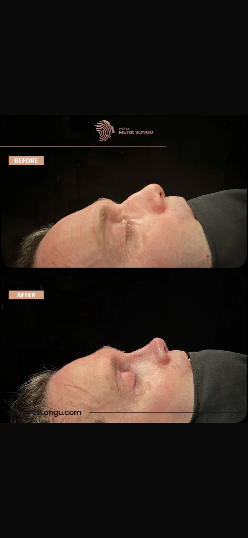 Rinoplastie de Revizie Înainte & După