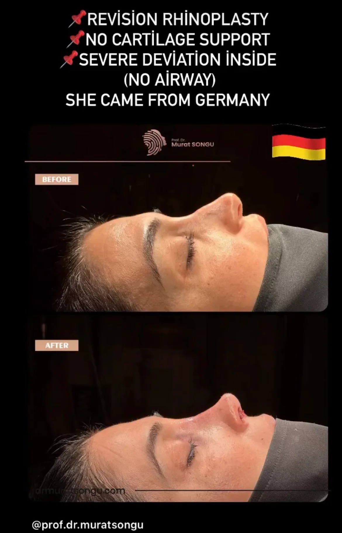 Rinoplastie de Revizie Înainte & După