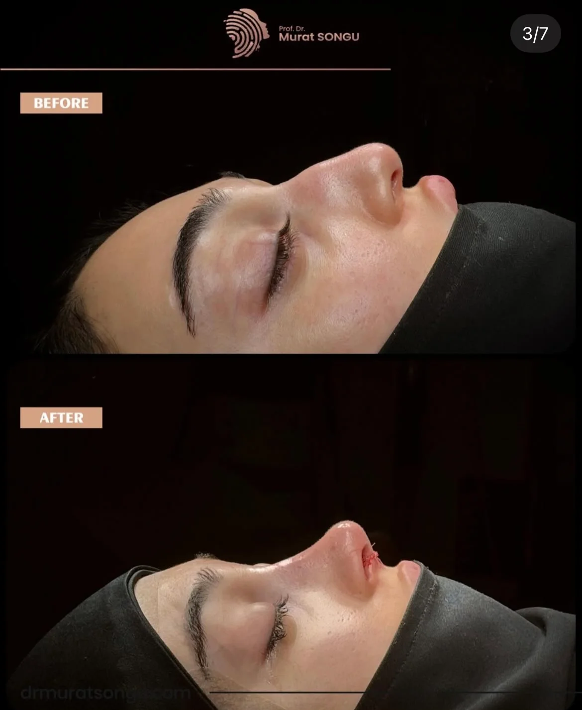 Rinoplastie de Revizie Înainte & După