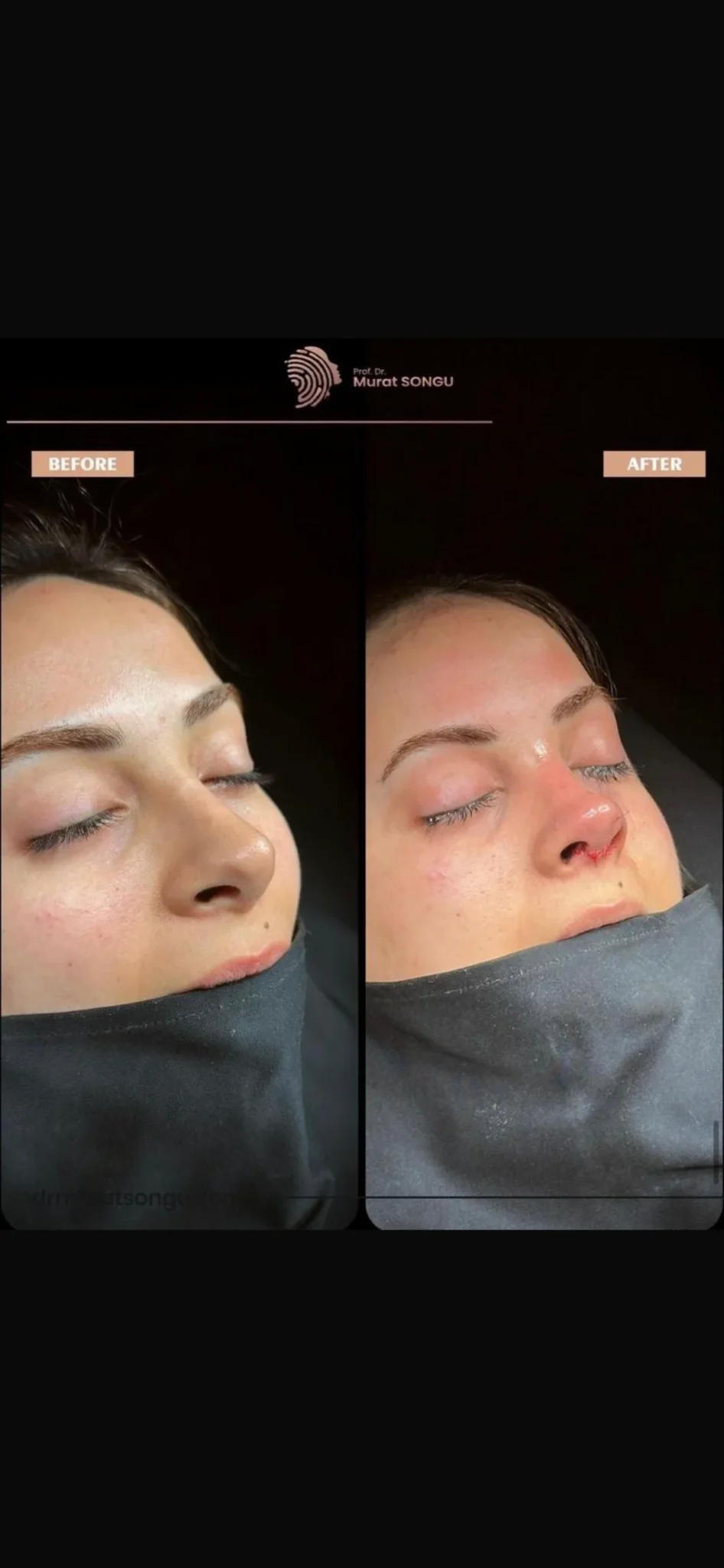 Rinoplastie de Revizie Înainte & După