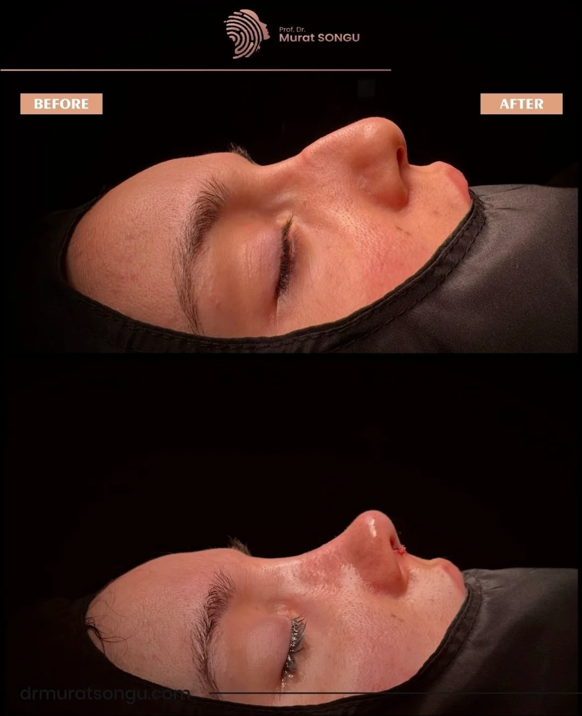Thick Skin Rhinoplasty Before and After