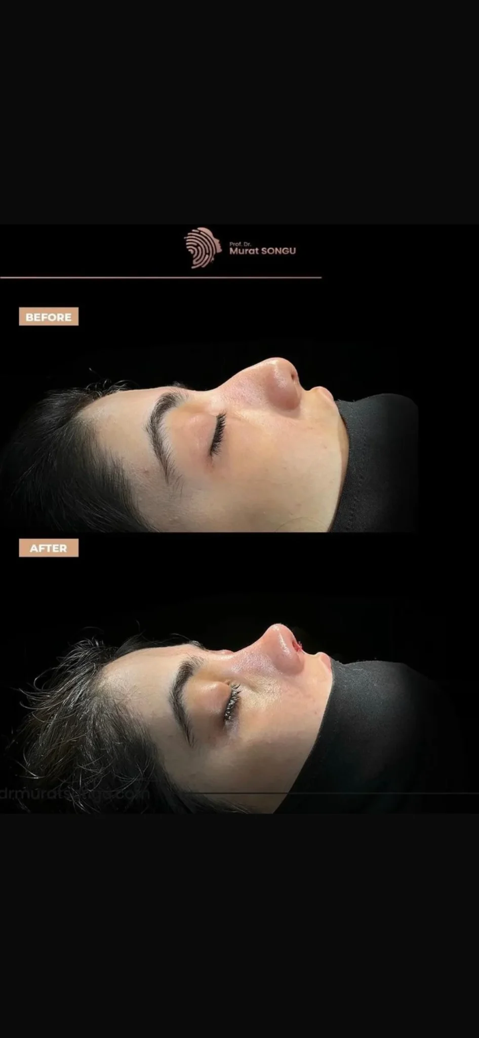 Thick Skin Rhinoplasty Before and After