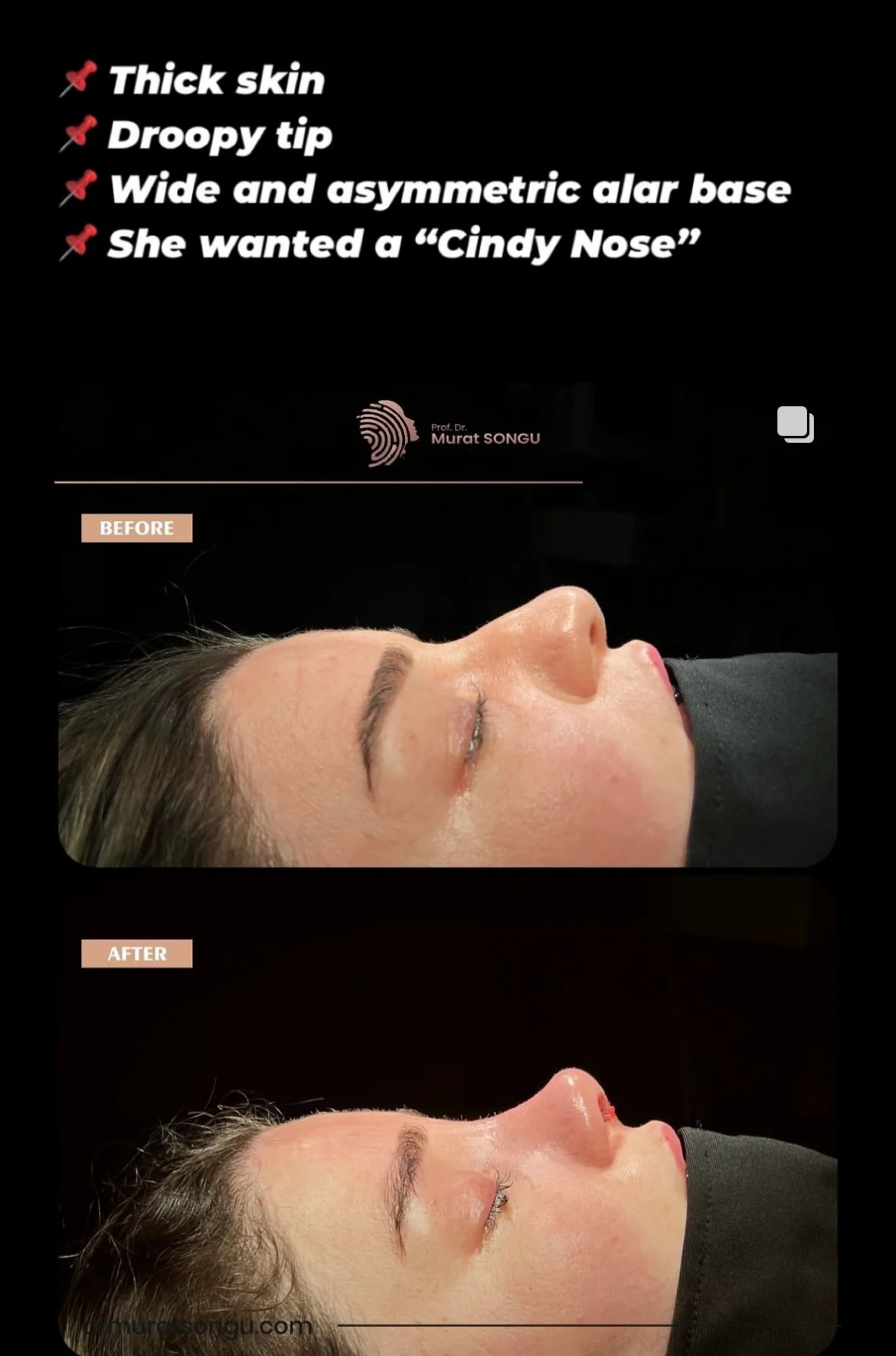 Thick Skin Rhinoplasty Before and After