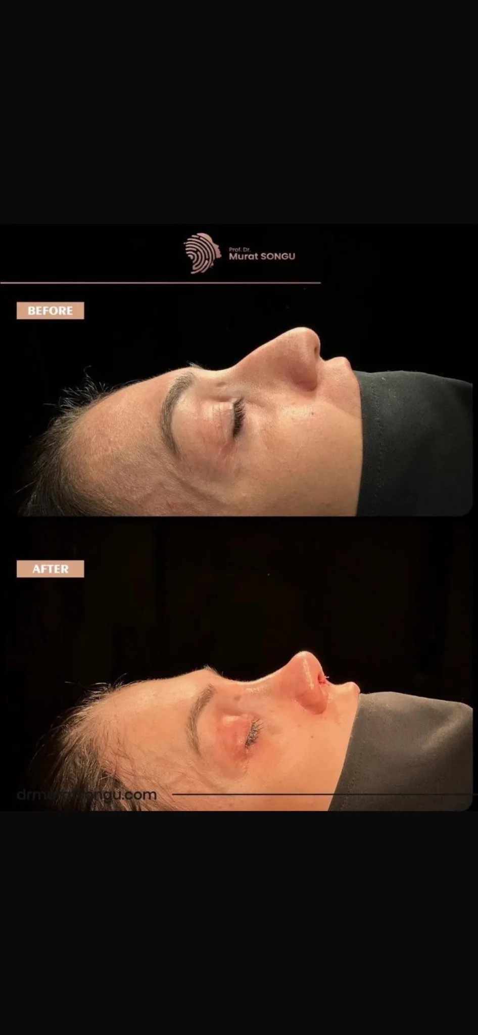 Thick Skin Rhinoplasty Before and After