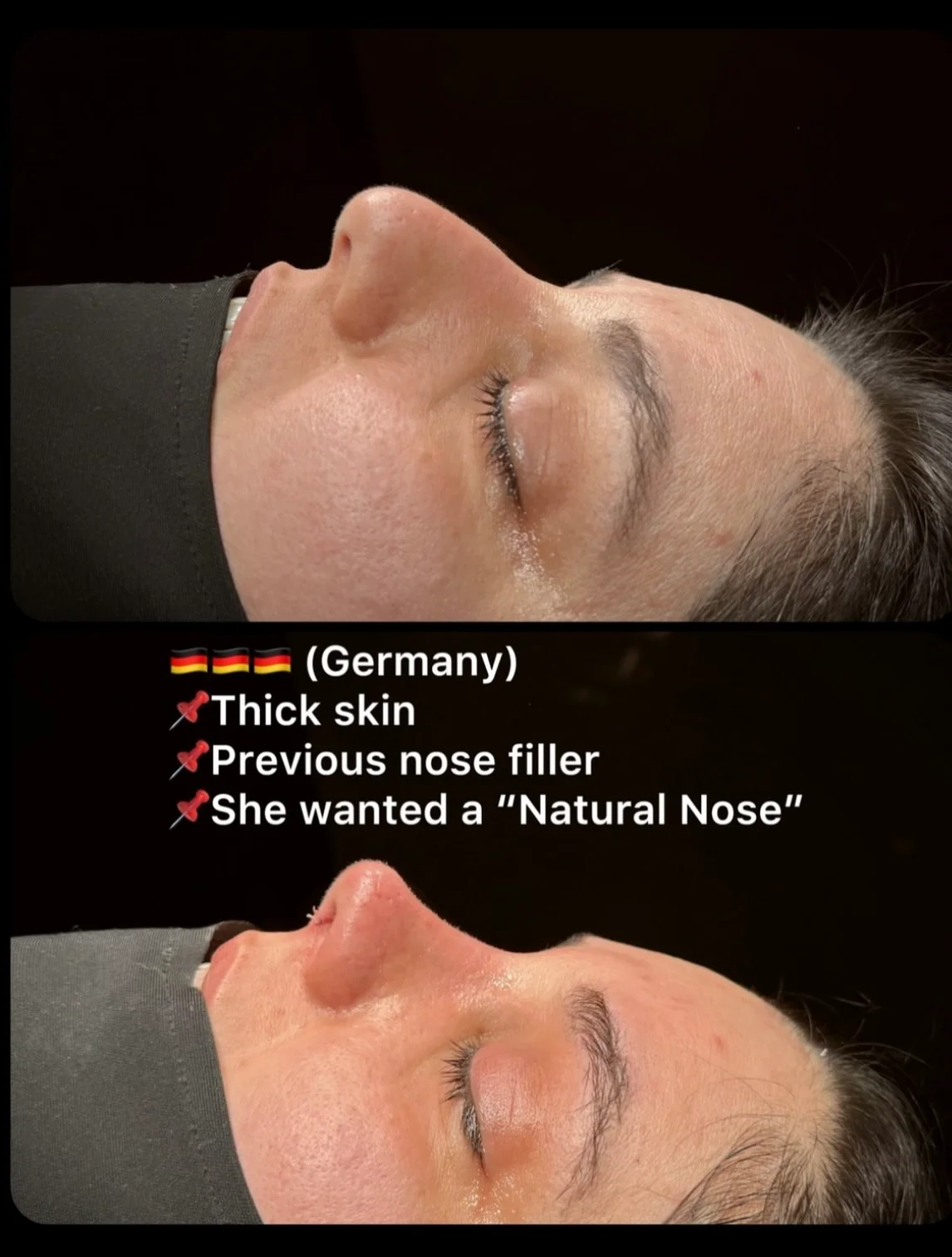 Thick Skin Rhinoplasty Before and After