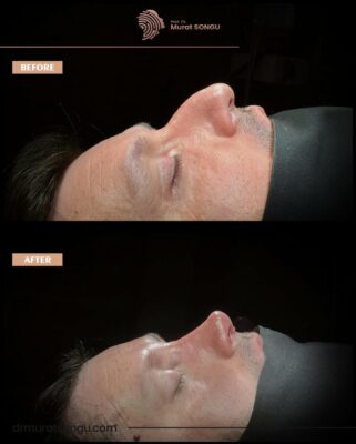roman nose rhinoplasty before after