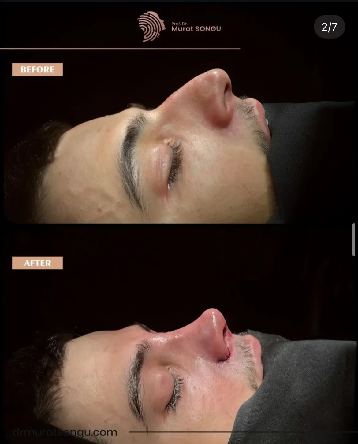 ניתוח אף חוזר לפני ואחרי