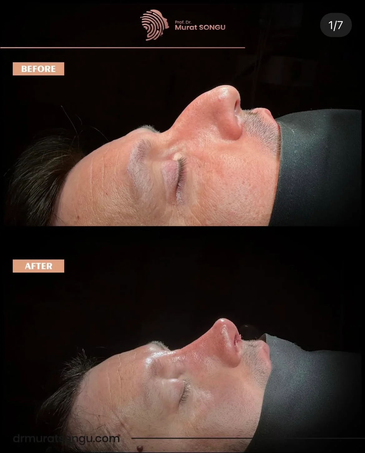 تجميل الأنف للرجال قبل وبعد تجميل الأنف للرجال قبل وبعد