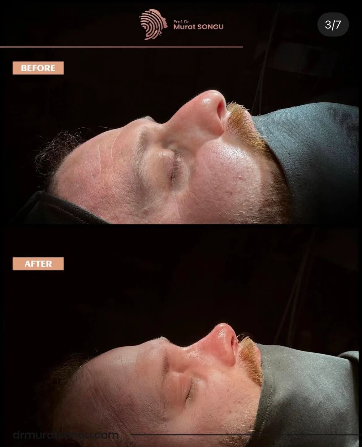 تجميل الأنف للرجال قبل وبعد تجميل الأنف للرجال قبل وبعد
