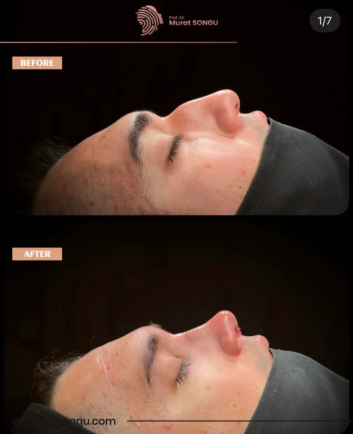 تجميل الأنف للرجال قبل وبعد تجميل الأنف للرجال قبل وبعد