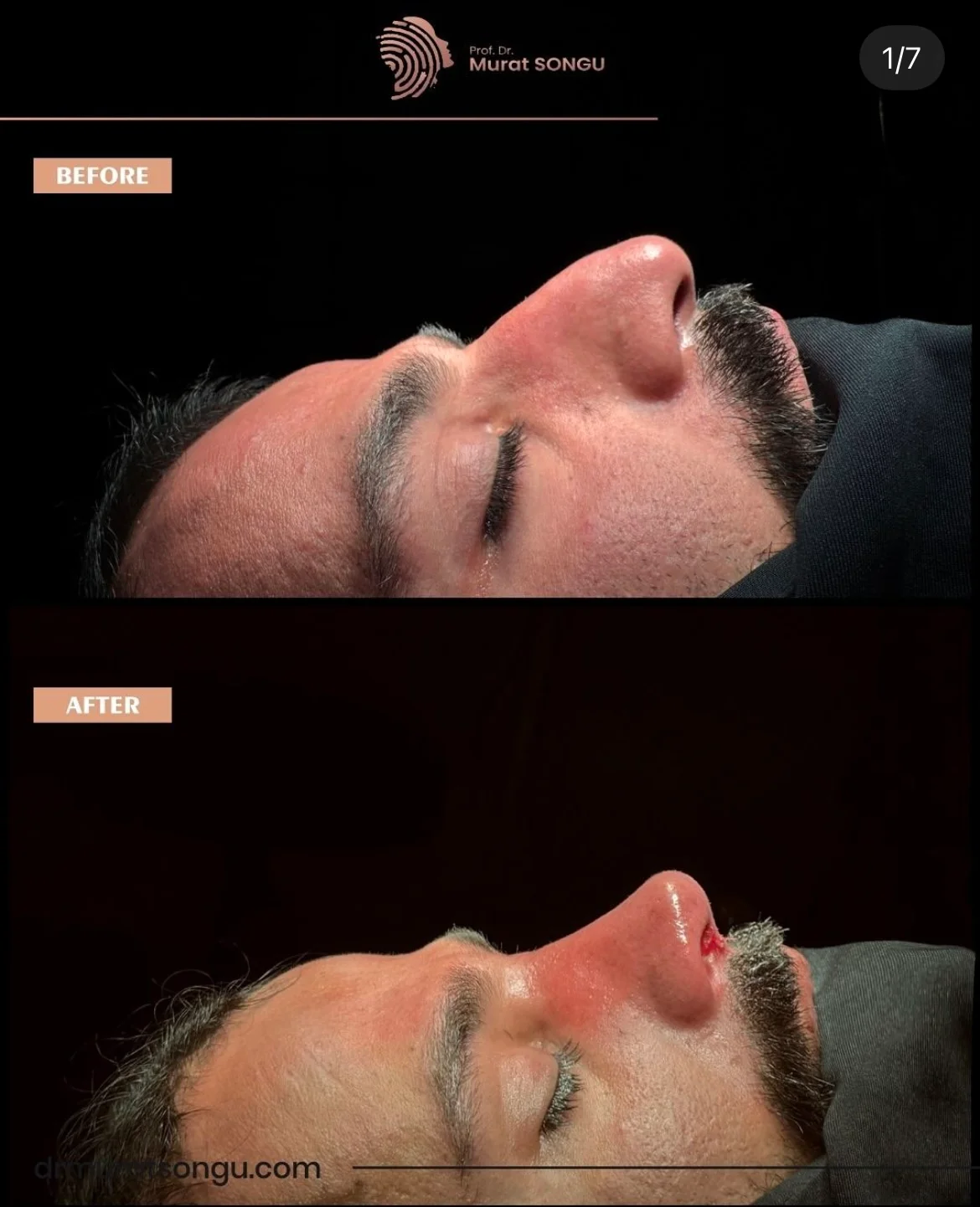 تجميل الأنف للرجال قبل وبعد تجميل الأنف للرجال قبل وبعد