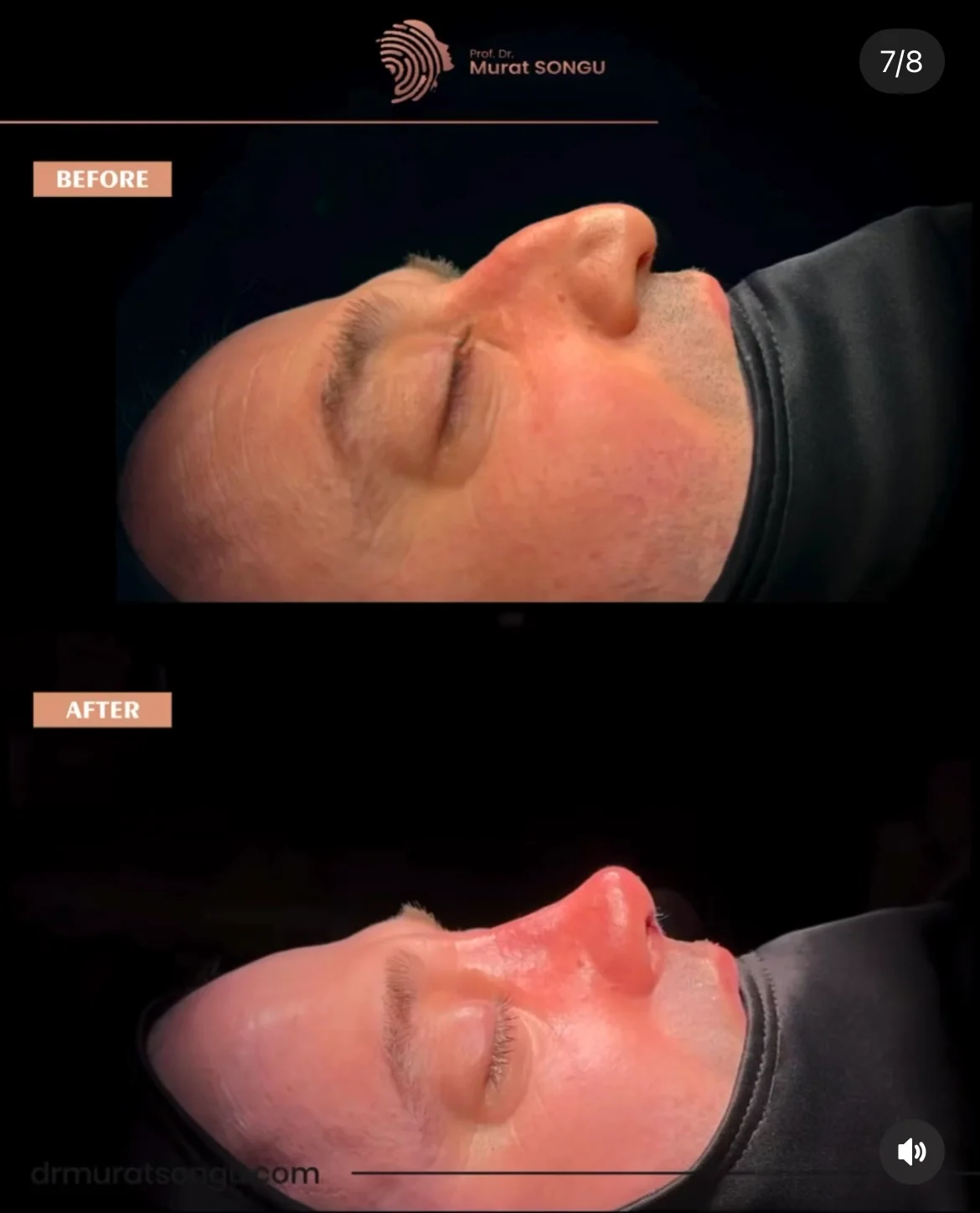 تجميل الأنف للرجال قبل وبعد تجميل الأنف للرجال قبل وبعد