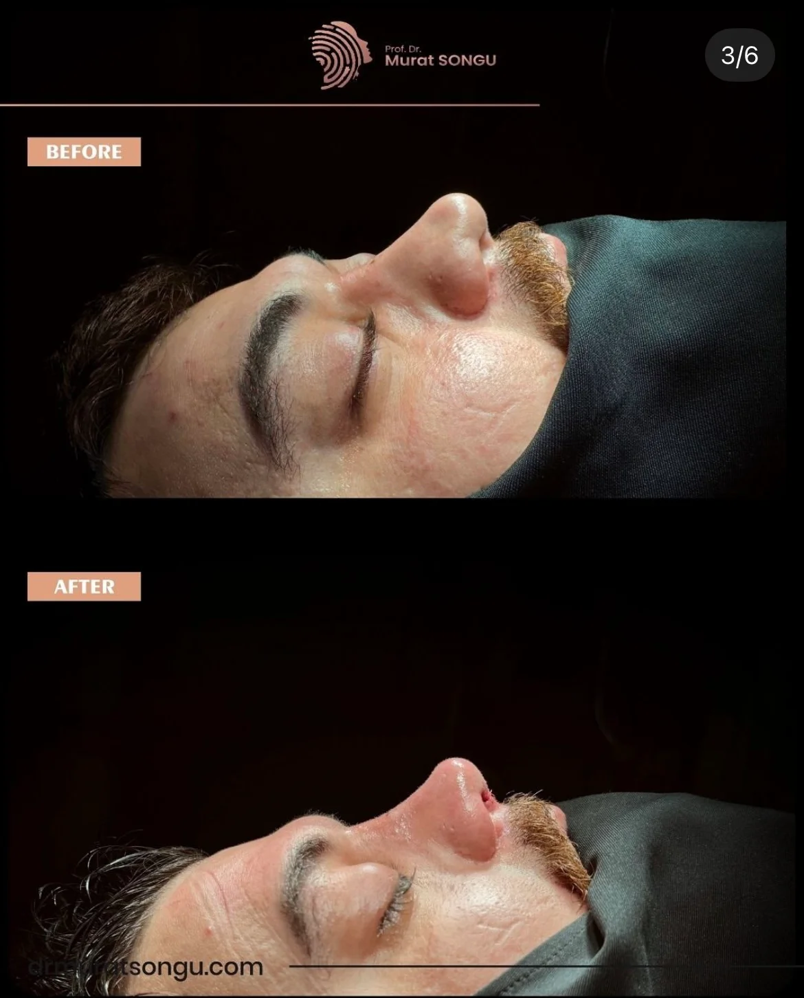 تجميل الأنف للرجال قبل وبعد تجميل الأنف للرجال قبل وبعد