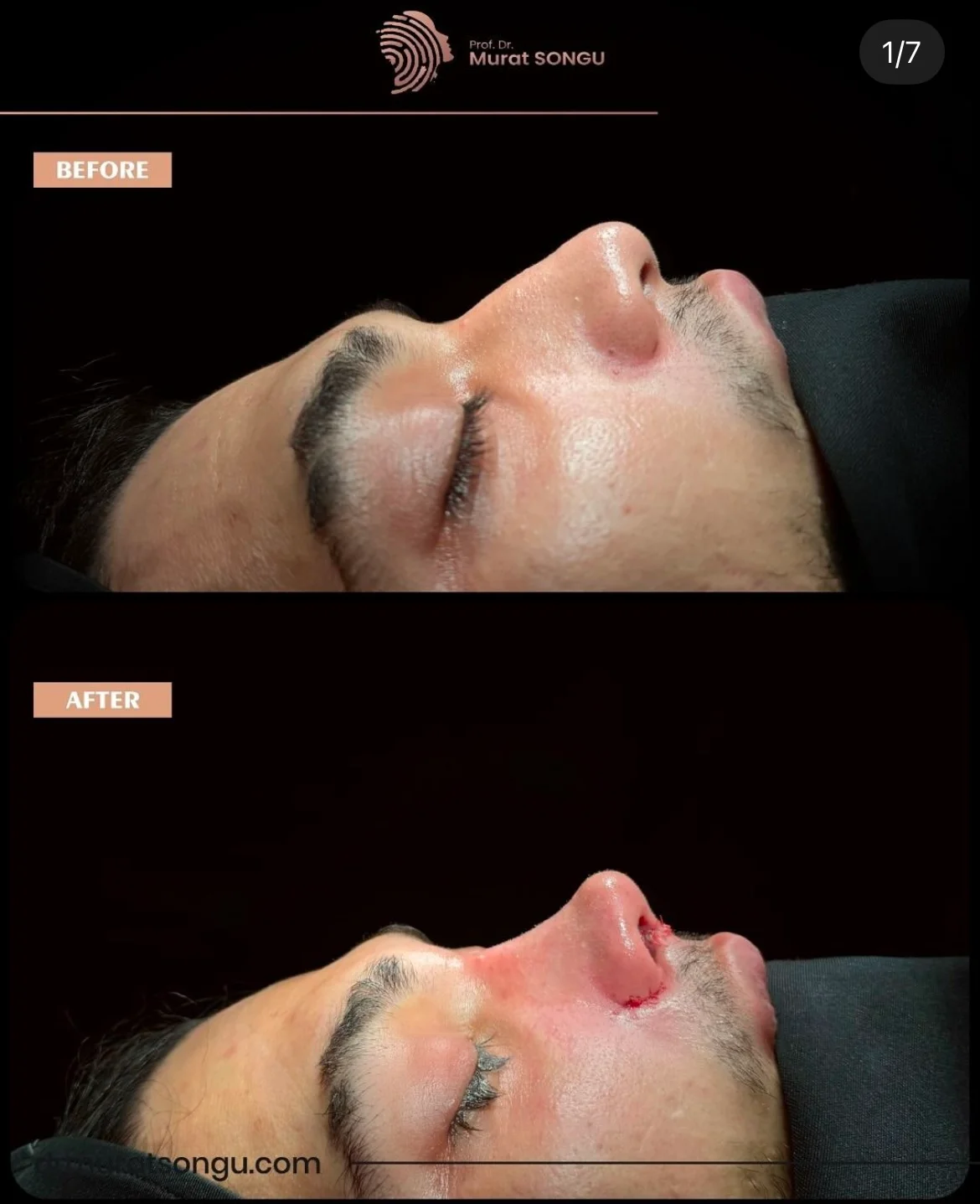 تجميل الأنف للرجال قبل وبعد تجميل الأنف للرجال قبل وبعد