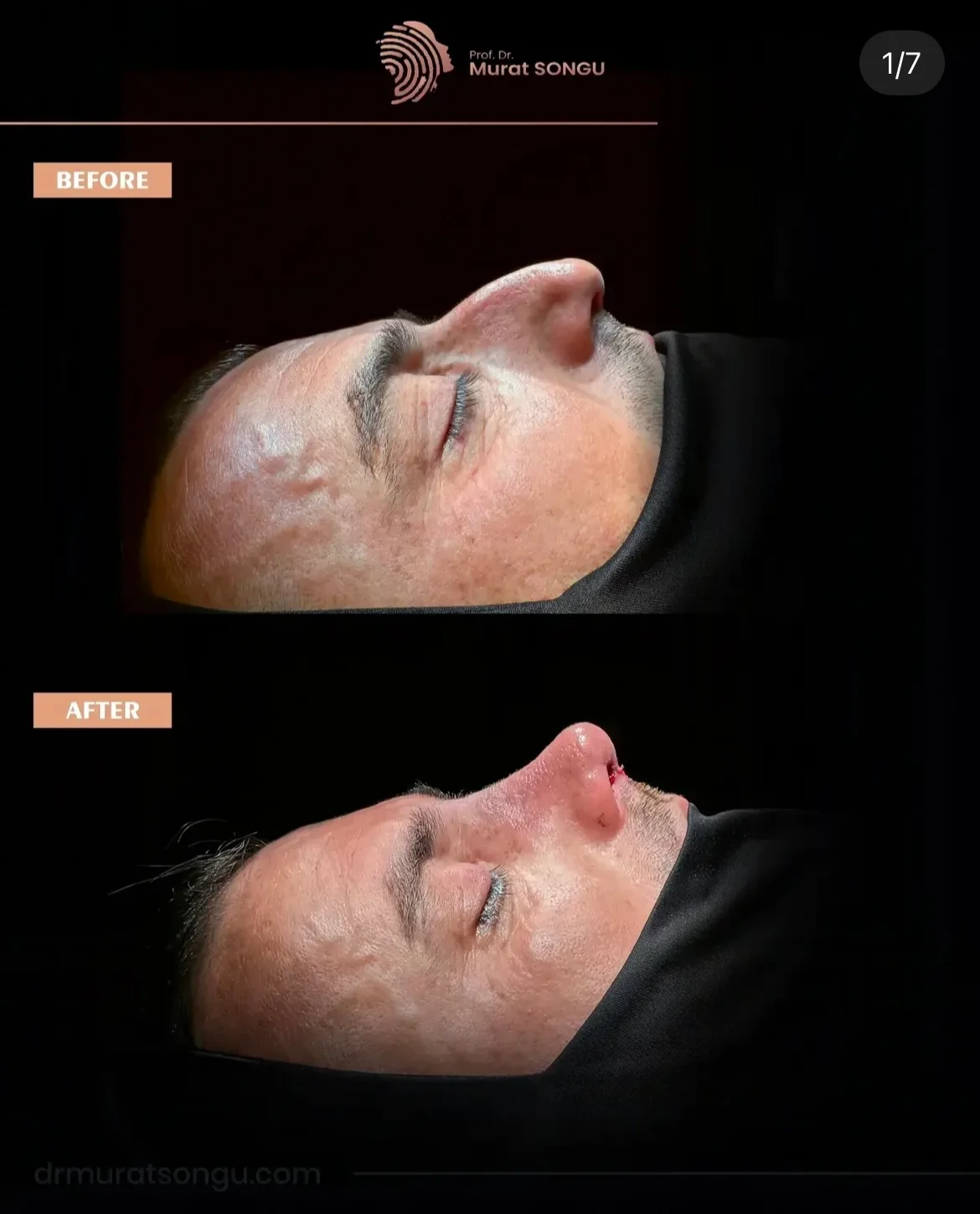 تجميل الأنف للرجال قبل وبعد تجميل الأنف للرجال قبل وبعد