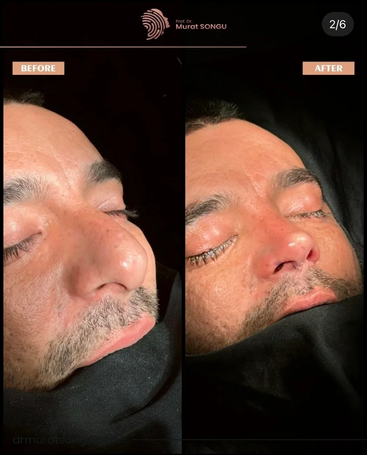 تجميل الأنف للرجال قبل وبعد تجميل الأنف للرجال قبل وبعد